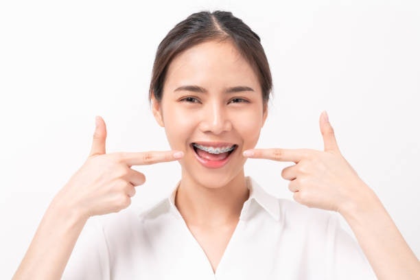 สำหรับคนจัดฟันขอแนะนำให้ใช้ยาสีฟันสูตรที่ผลิตมาเพื่อคนจัดฟันโดยเฉพาะ