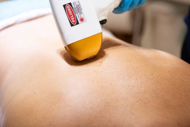 รอยแตกลายระดับตื้นถึงปานกลาง ผิวขาวถึงสองสี เลือก Fractional CO2 Laser