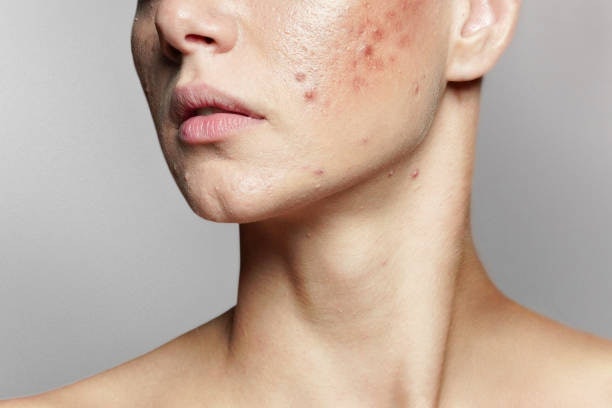 กรณีคนที่มีปัญหาสิวควรเลือกใช้โฟมล้างหน้าญี่ปุ่นในกลุ่ม Acne โดยเฉพาะเพื่อเพิ่มประสิทธิภาพการรักษาสิว