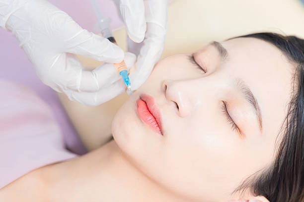 ฟิลเลอร์ยี่ห้อ Juvederm เนื้อเนียนละเอียด บวมน้อย