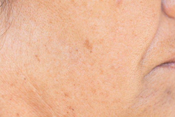รักษาฝ้า กระ จุดด่างดำ และริ้วรอย เลือก PicoSure / PicoSure Pro