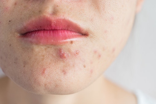 ผิวแพ้ง่ายให้เลือกเซรั่มสูตรที่ระบุว่า Hypoallergenic ที่อ่อนโยนและไม่มีสารระคายเคือง