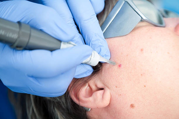 เลเซอร์กระเนื้อ เลือก CO2 Laser หรือ Ablative Erbium Yag Laser