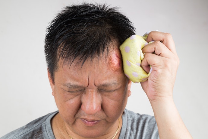 หลีกเลี่ยงส่วนผสมของสเตียรอยด์ในยาทาแก้ฟกช้ำ บนใบหน้า