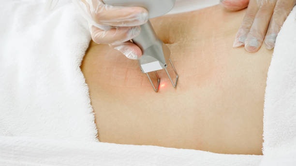 รอยแตกลายลึกหรือบริเวณผิวหนา เลือก Long Pulse Nd:YAG Laser