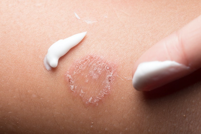 ยารักษาเชื้อราสำหรับกลุ่มเชื้อราเดอมาโทไฟท์ (Dermatophytes)