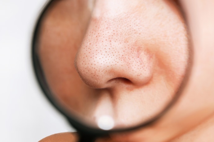ปัญหาสิวเสี้ยน เลือกโฟมล้างหน้าลดสิวเสี้ยนที่มีส่วนผสมของเม็ดสครับ