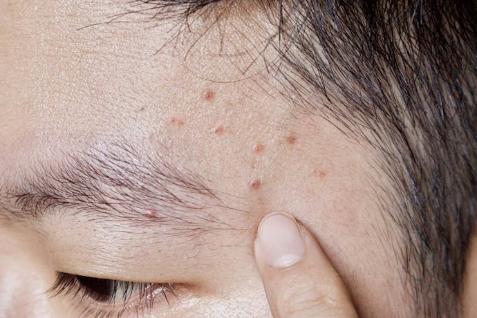 สำหรับคนหนังศีรษะมันเป็นสิวง่าย เลือกสูตร Micellar/สูตรลดสิว