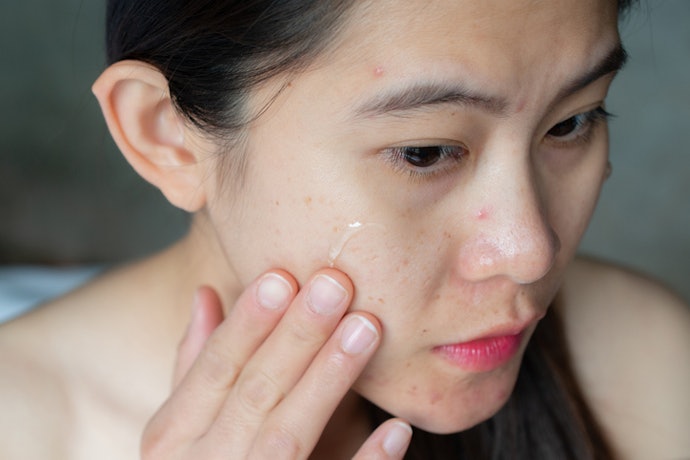 สำหรับผู้ที่มีสิวอักเสบร่วมด้วย เลือกยาที่มีส่วนผสมของสารต้านเชื้อแบคทีเรีย