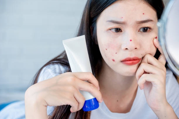 สำหรับคนผิวแพ้ง่ายที่มีปัญหาสิว เลือกโฟมล้างหน้าที่มีส่วนผสมช่วยลดการอักเสบ