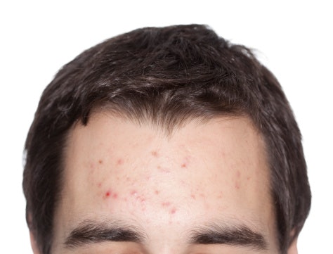 สิวอักเสบ (Inflammatory Acne)