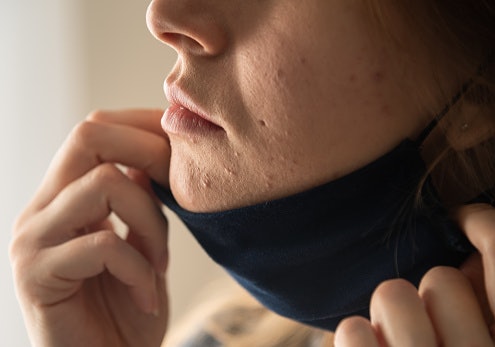 สิวไม่อักเสบหรือสิวอุดตัน (Non-Inflammatory Acne)