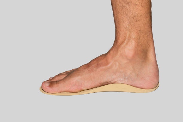 อุ้งเท้าแบน แนะนำรองเท้าที่มี Arch Support และพื้นแข็งปานกลาง