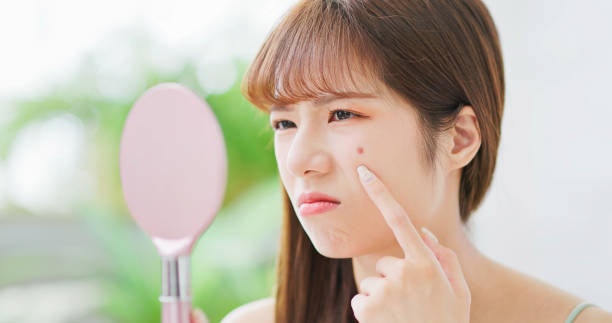 คนเป็นสิว เลือกแป้งผสมรองพื้นสูตรที่สำหรับคนเป็นสิวและเป็นสูตร Non-commedogenic