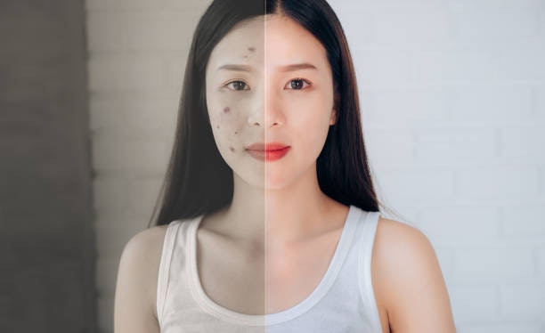 ปัญหาสิว เลือกโฟมล้างหน้าสูตรลดสิว หรือ Anti-Acne โดยเฉพาะ