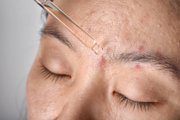 สำหรับผู้ทื่มีปัญหาสิว/ผิวแพ้ง่าย เลือกสูตรที่มีส่วนผสมของสารกลุ่มปลอบประโลมผิว