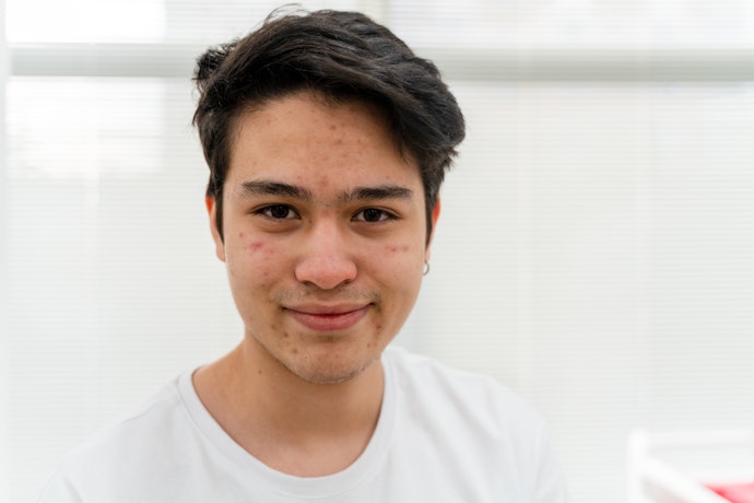 สำหรับผู้ชายที่มีปัญหาสิวอักเสบ เลือกครีมทาหน้าสูตรสำหรับคนเป็นสิวโดยเฉพาะ
