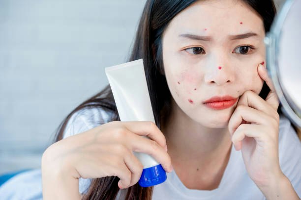 สำหรับคนผิวแพ้ง่ายที่มีปัญหาสิว เลือกโฟมล้างหน้าที่มีส่วนผสมช่วยลดการอักเสบ