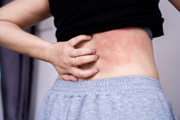 เริมรุนแรงหรือมีอาการอื่น เช่น คัน หนอง เลือกตัวยากลุ่ม Supportive Treatment ร่วมด้วย